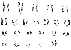 Caryotype féminin